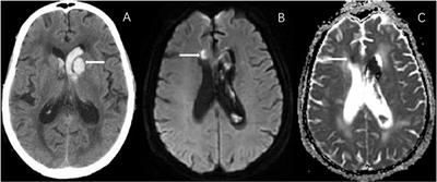 Association of Renal Dysfunction With Remote Diffusion-Weighted Imaging Lesions and Total Burden of Cerebral Small Vessel Disease in Patients With Primary Intracerebral Hemorrhage